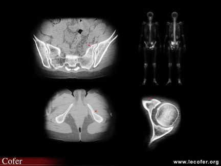 Scintigraphie osseuse-scanner : triple fracture sacrum, cotyle, ischion gauches