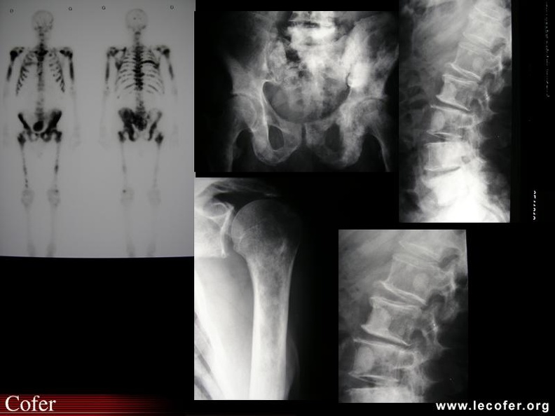 Métastases multiples d’un cancer de prostate. 000000000711s.jpg