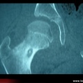 Ostéome ostéoïde du col fémoral