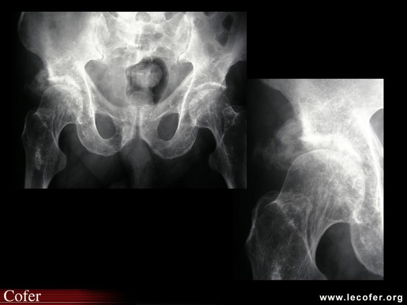 Ostéoarthropathie nerveuse de hanche. 000000000721s.jpg