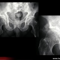 Ostéoarthropathie nerveuse de hanche
