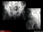 Ostéoarthropathie nerveuse de hanche