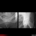 Chondrocalcinose articulaire de la symphyse pubienne et de la coxo-fémorale