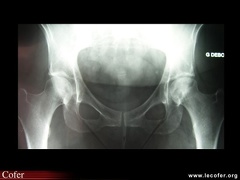 Ostéonécrose aseptique des deux têtes fémorales