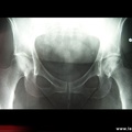 Ostéonécrose aseptique des deux têtes fémorales