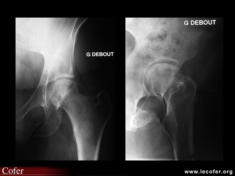 Ostéonécrose aseptique de la tête fémorale gauche : le faux profil de Lequesne permet de mieux faire apparaître la zone infarcie (méplat). 000000000786s.jpg