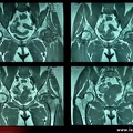 Ostéonécrose aseptique des deux têtes fémorales
