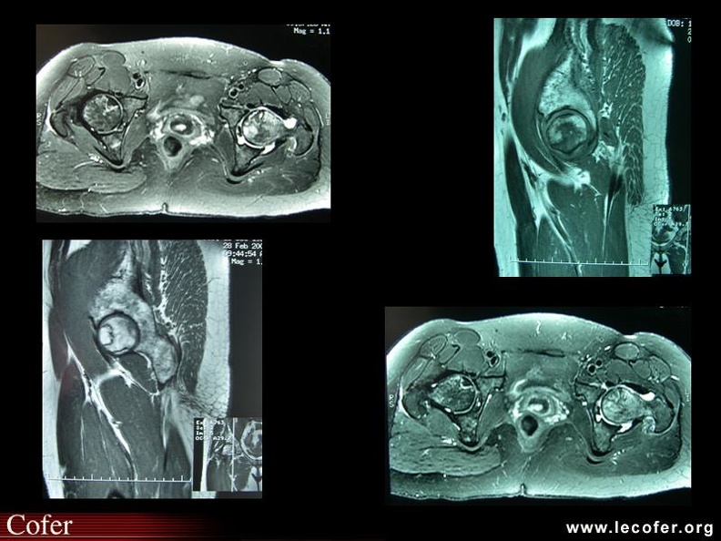 Coupes sagittales T1 coupes transversales T2 liseré hypo-T1 hyper-T2 de nécrose et réaction inflammatoire de voisinage à gauche aspect plus modéré à droite (asymptomatique) en T2 on note un épanchement articulaire gauche réactionnel. 000000000788s.jpg