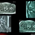 Ostéonécrose aseptique des deux têtes fémorales