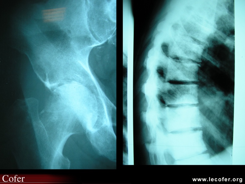 Coxite infectieuse. Pincement de l'interligne coxo-fémoral global, déminéralisation et destruction osseuse. 0102020041.jpg