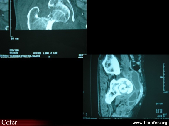 Coxite infectieuse, coxite septique : radiographies, radios