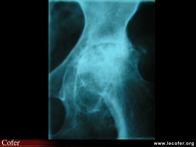 Coxite rhumatismale : radiographies, radios