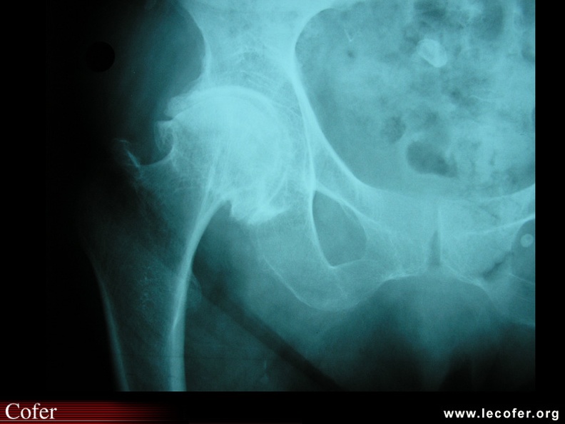 Coxarthose engainante. Condensation de l'acétabulum et de la tête fémorale avec ostéophytose. 010203006.jpg