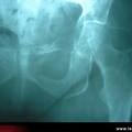 Métastase osseuse : radiographies, radios