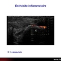 Enthésite, pelvispondylite rhumatismale, spondylarthropathie, SpA, spondylarthrite ankylosante, échographie