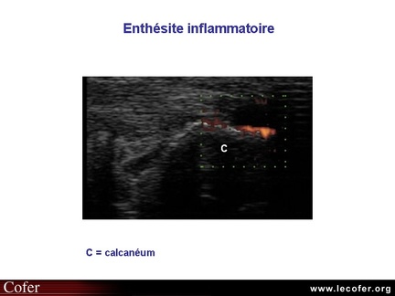 Enthésite, pelvispondylite rhumatismale, spondylarthropathie, SpA, spondylarthrite ankylosante, échographie