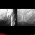 Fracture des branches ischio-pubiennes et ilio-pubiennes