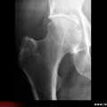 Radiographie de face de la hanche