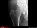 Radiographie de face de la hanche