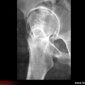 Radiographie de la hanche : faux profil de Lequesne