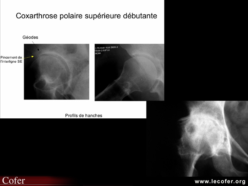 Différents stades de la coxarthrose