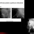 Différents stades de la coxarthrose