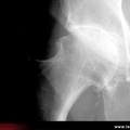 Coxarthrose concentrique