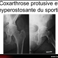 Coxarthrose hyperostosante