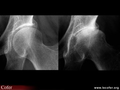 Coxarthrose destructrice rapide