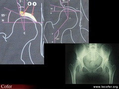 Coxarthrose secondaire à une dysplasie