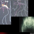 Coxarthrose secondaire à une dysplasie