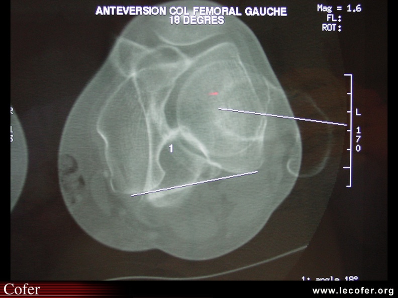 Scanner antéversion de 18 degrés du col fémoral. 070002074.jpg