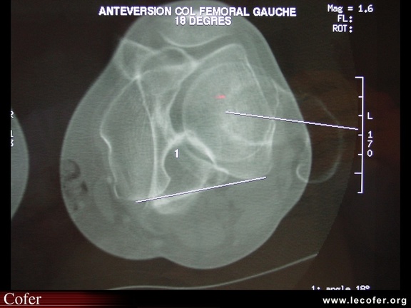 Antéversion du col fémoral