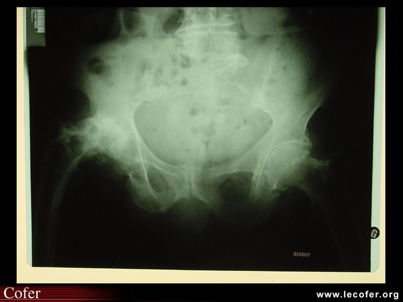 Coxarthrose évoluée avec Paget de la tête fémorale. 070002078.jpg