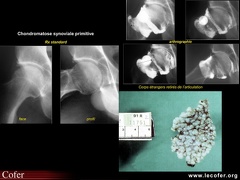 Coxarthrose secondaire à une ostéochondromatose