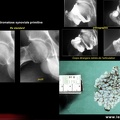 Coxarthrose secondaire à une ostéochondromatose