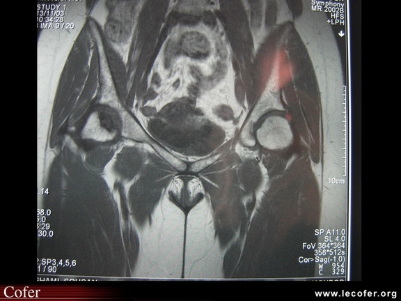 Ostéonécrose de la tête fémorale en IRM