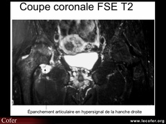 Ostéonécrose de la tête fémorale : apport de l’IRM : épanchement