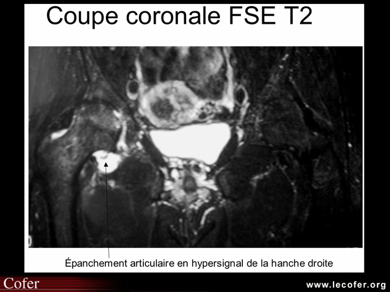 Ostéonécrose de la tête fémorale : apport de l’IRM : épanchement