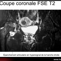 Ostéonécrose de la tête fémorale : apport de l’IRM : épanchement