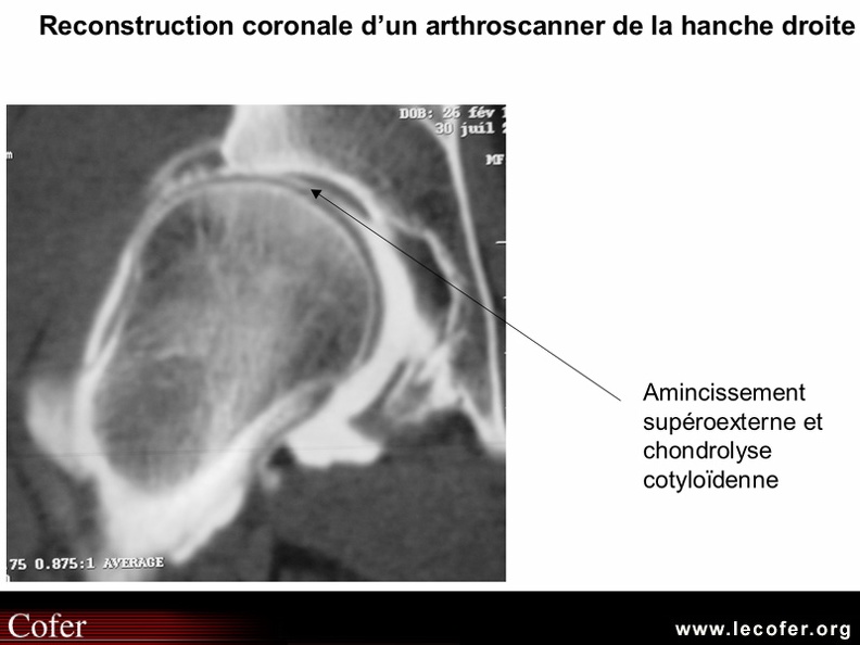 Arthroscanner : chondropathie isolée