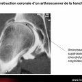 Arthroscanner : chondropathie isolée