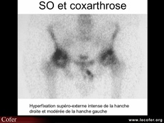 Coxarthrose : scintigraphie