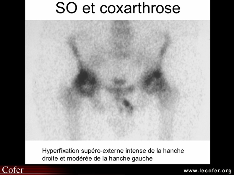 Coxarthrose : scintigraphie