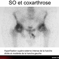 Coxarthrose : scintigraphie