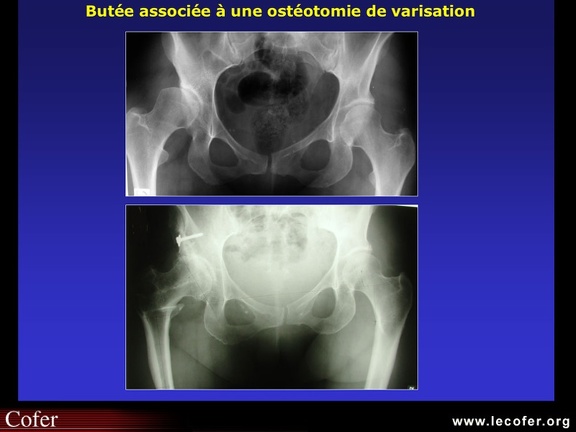 Coxarthrose : chirurgie préventive