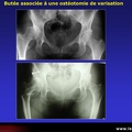 Coxarthrose : chirurgie préventive