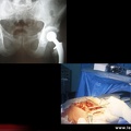 Prothèse totale de la hanche
