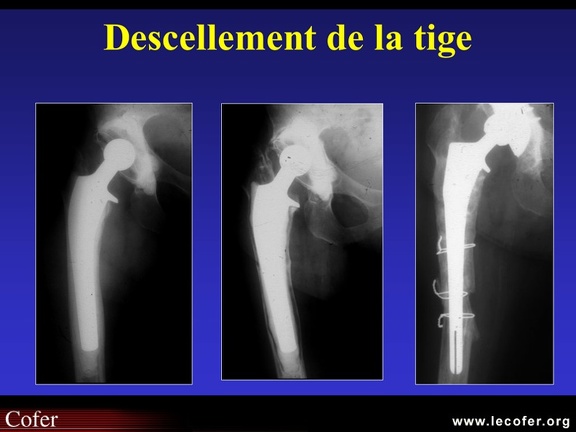 Chirurgie : signes de descellement