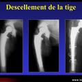 Chirurgie : signes de descellement